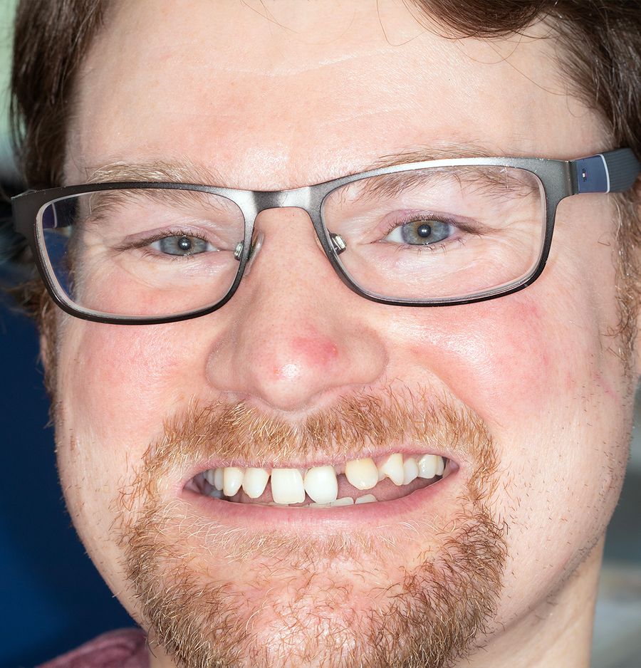 Dental bridge - before - Daniel Wilson